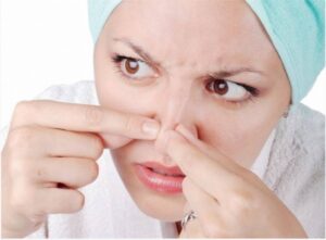 دستورخانگی برای رفع جوش سرسیاه