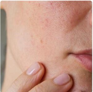 موارد استفاده از میکرونیدلینگ