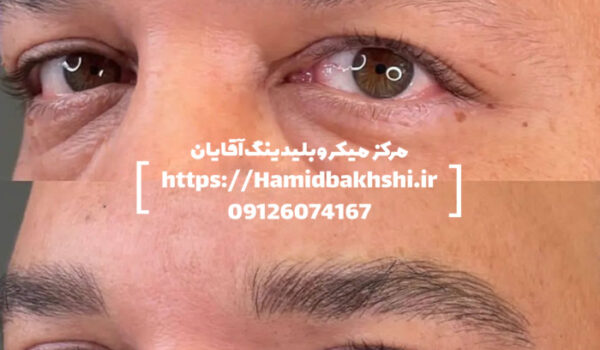 میکروبلیدینگ ابروی آقایان