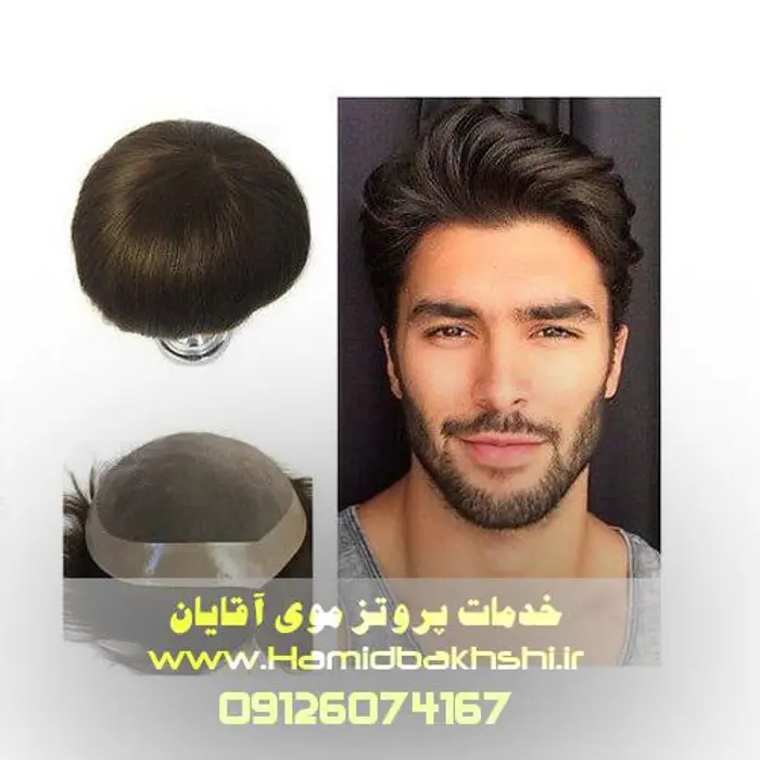 هزینه پروتز مو آقایان