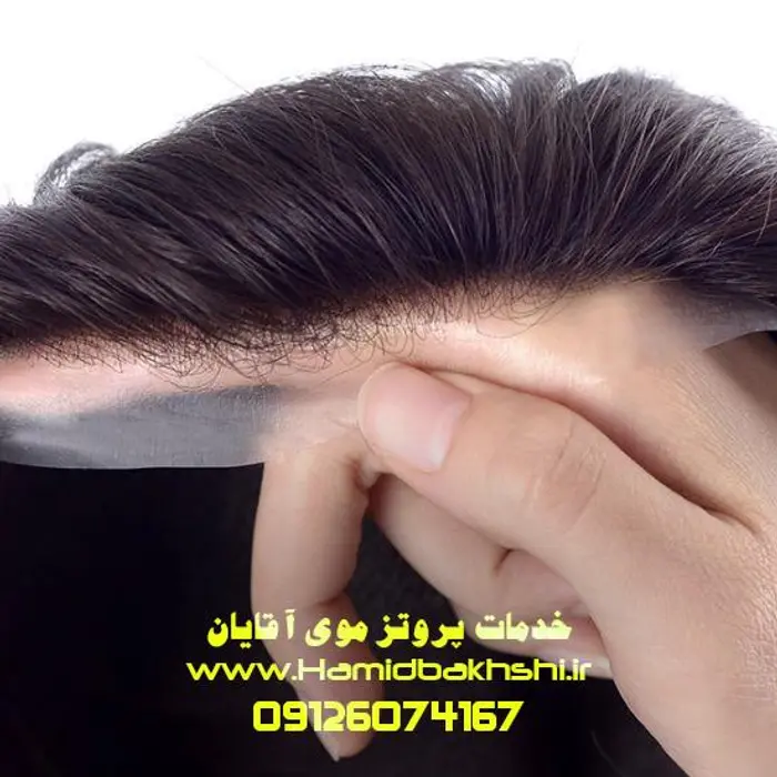هزینه پروتز مو آقایان چقدره؟