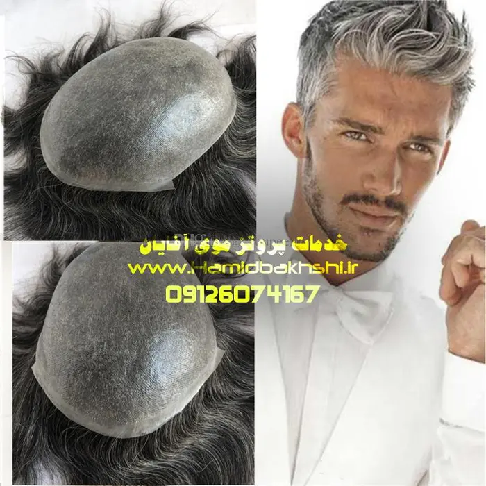 هزینه پروتز مو آقایان چقدره؟