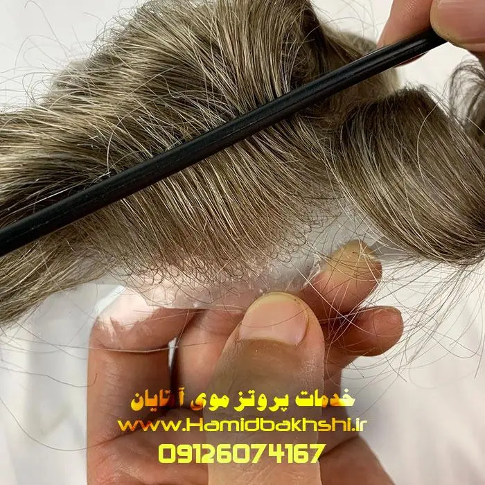 هزینه پروتز مو آقایان چقدره؟