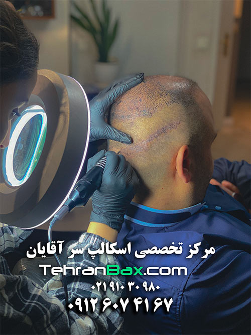 بهترین مرکز میکروپیگمنتیشن موی سر در تهران