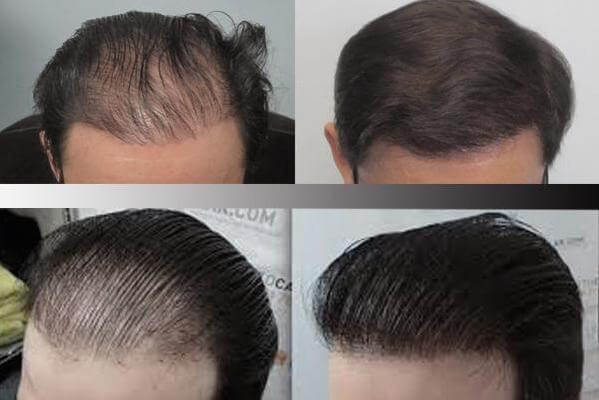 کاشت موی طبیعی به روشFIT و FUT