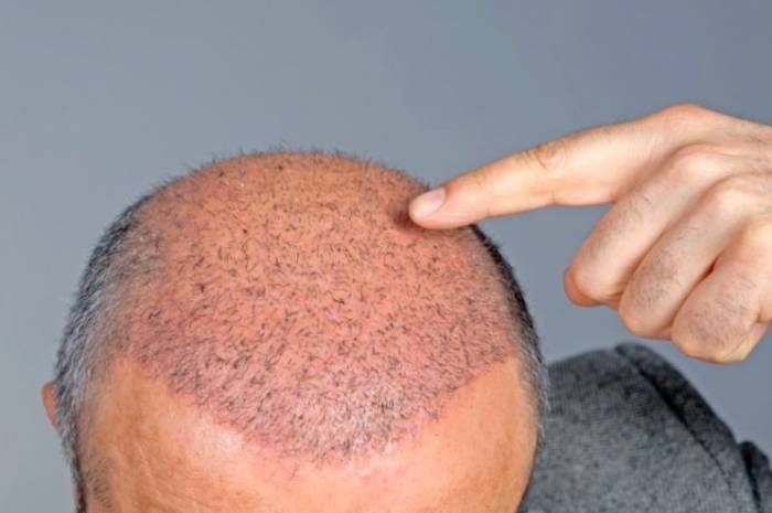 پنهان کردن خط کاشت مو