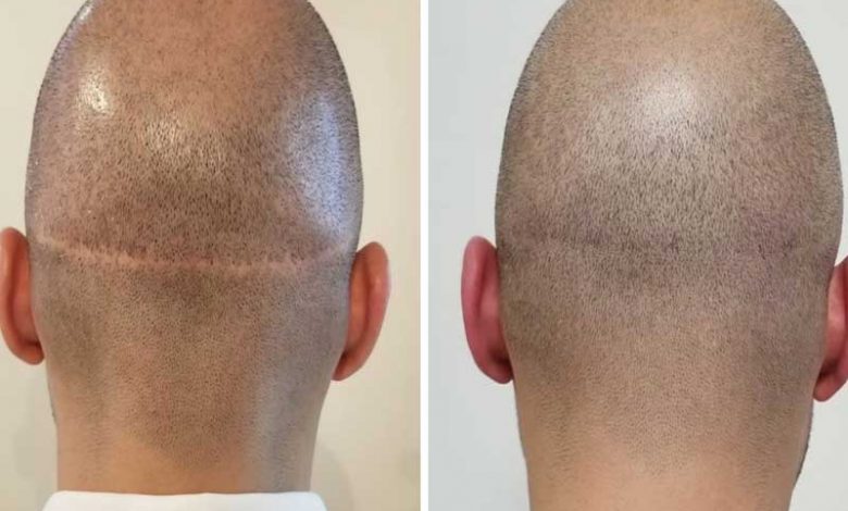 درمان ریزش سکه ای مو با میکروپیگمنتیشن