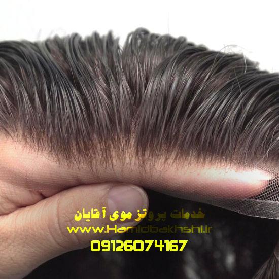 پروتز موی حرفه ای در تهران