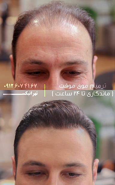 قیمت جدید پروتز موی آقایان در تهران