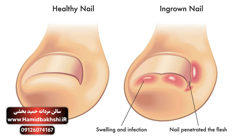 درمان ناخن داخل گوشت با پدیکور مردانه