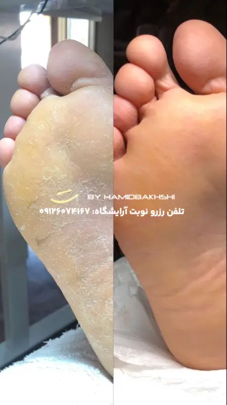 درمان ترک پا آقایان