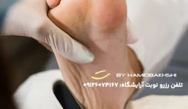 درمان ترک پا در مردان