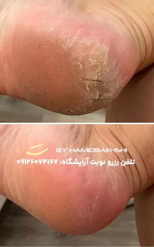 درمان ترک پا آقایان