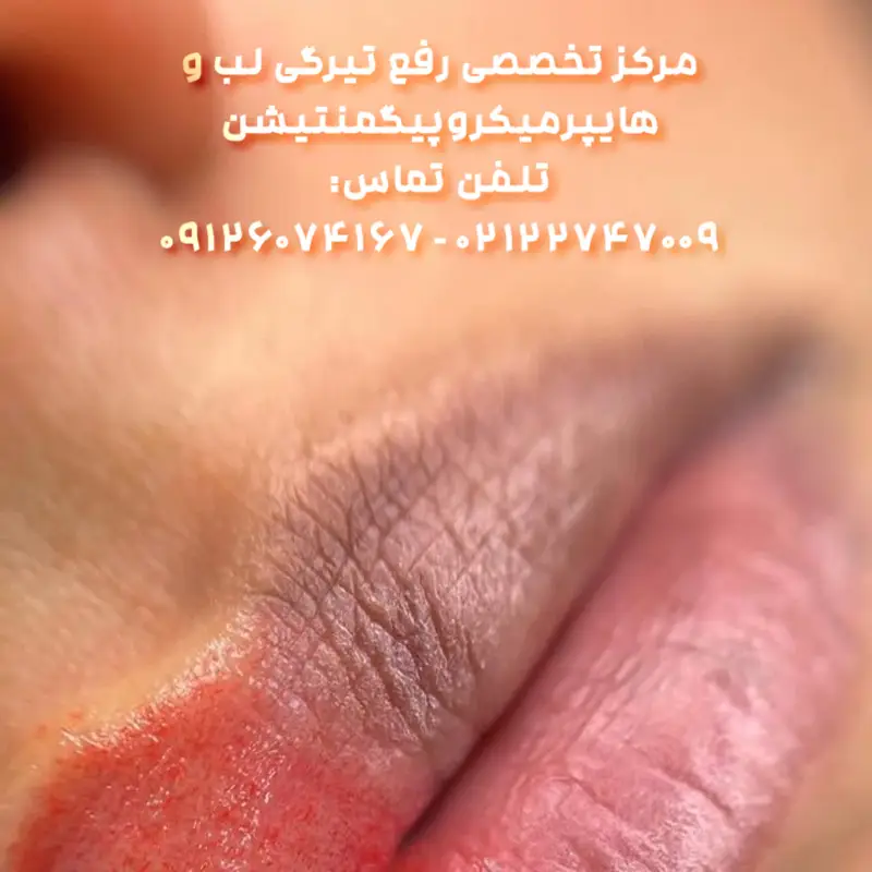 احیای رنگ لب