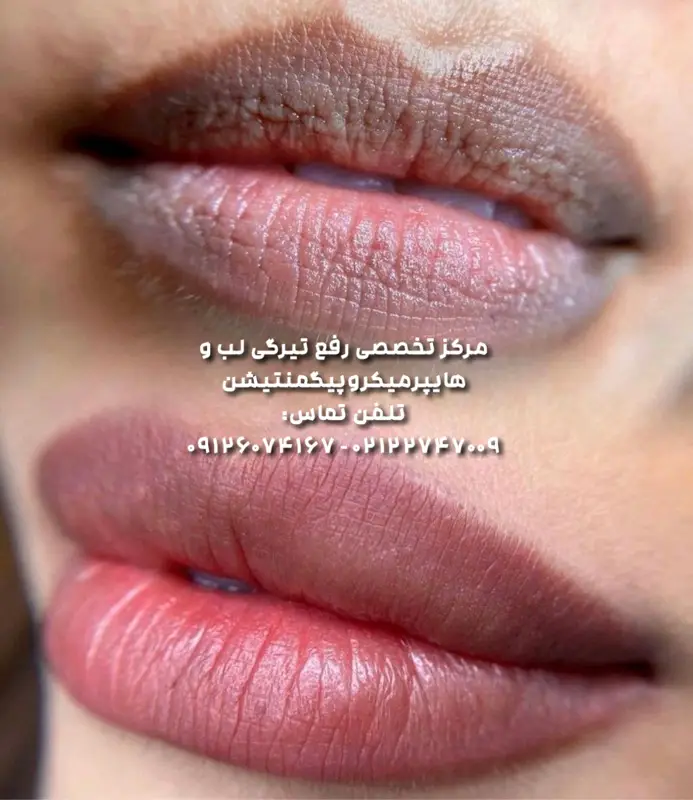 رفع تیرگی لب