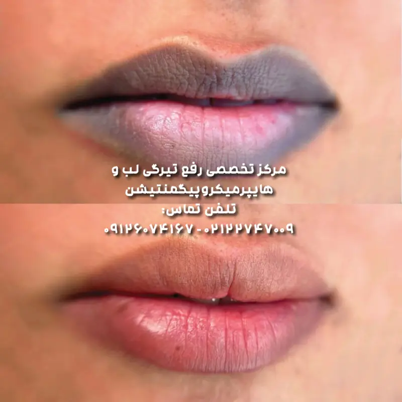 درمان سیاهی لب به روش ساده