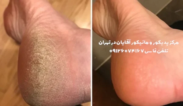 درمان ترک پا در آقایان با کفسابی مردانه