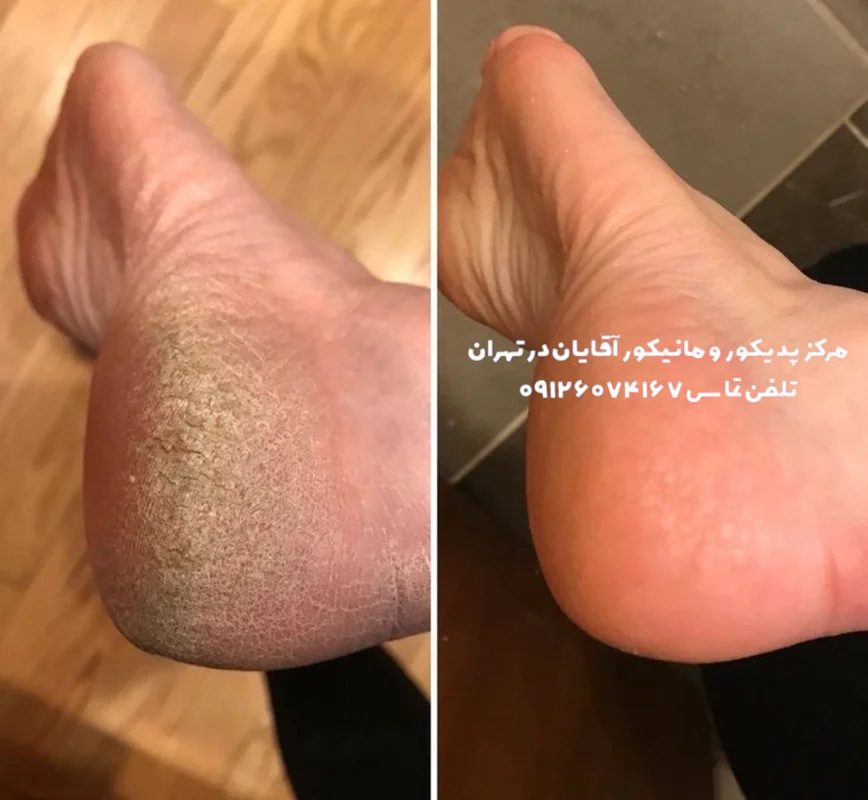 درمان ترک پا در آقایان با کفسابی مردانه