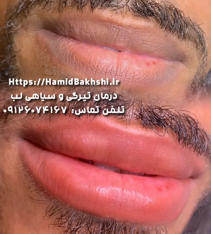 شیدینگ لب آقایان