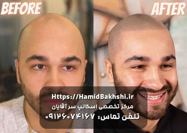 هزینه اسکالپ سر آقایان