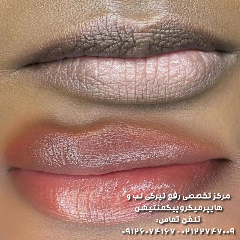 رفع تیرگی لب