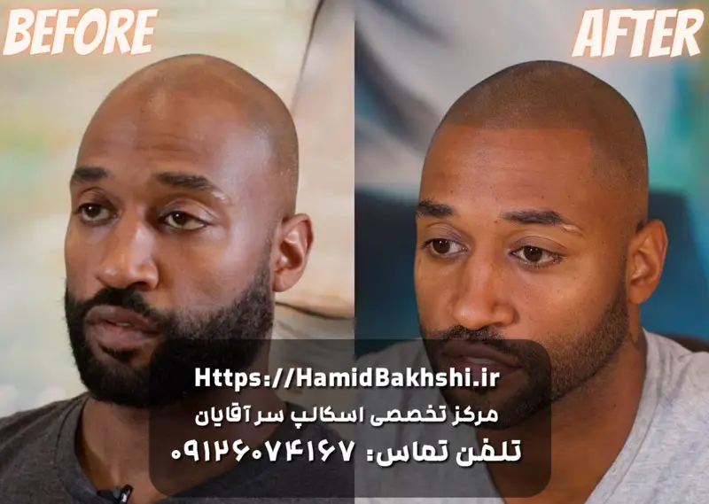 هزینه اسکالپ سر آقایان