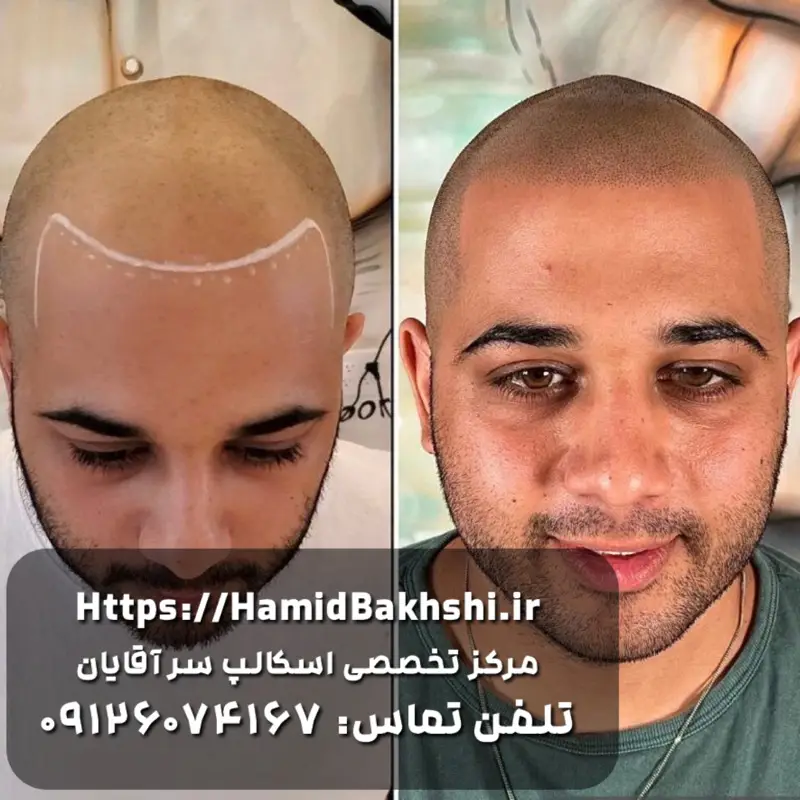 هزینه اسکالپ سر آقایان