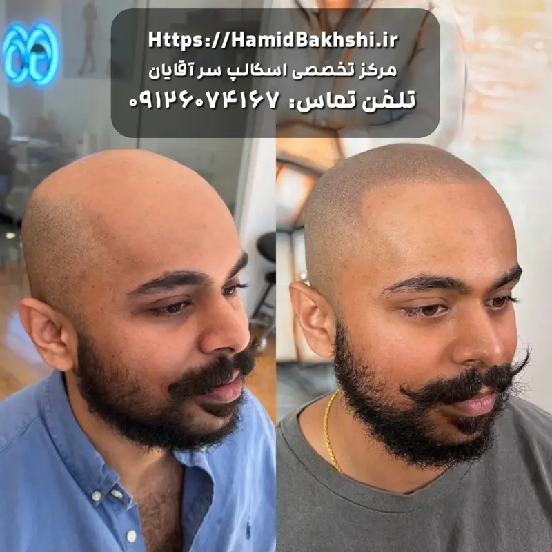 هزینه اسکالپ سر آقایان