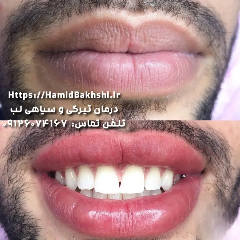 شیدینگ لب آقایان