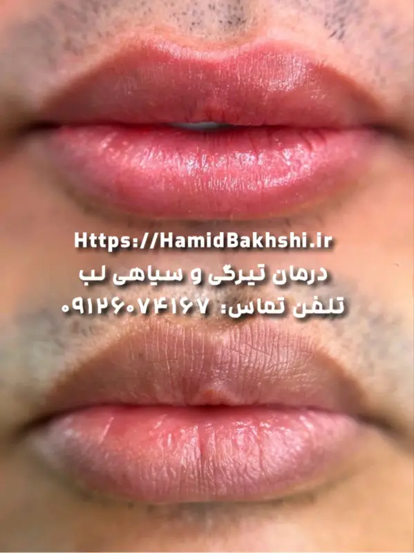 شیدینگ لب برای آقایان