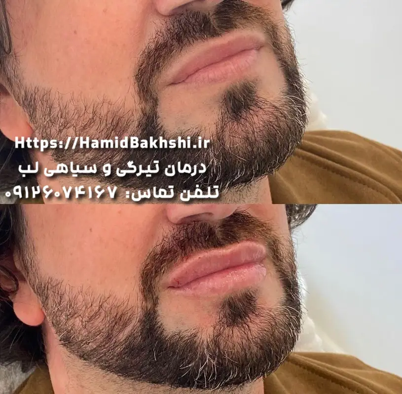 شیدینگ لب مردانه