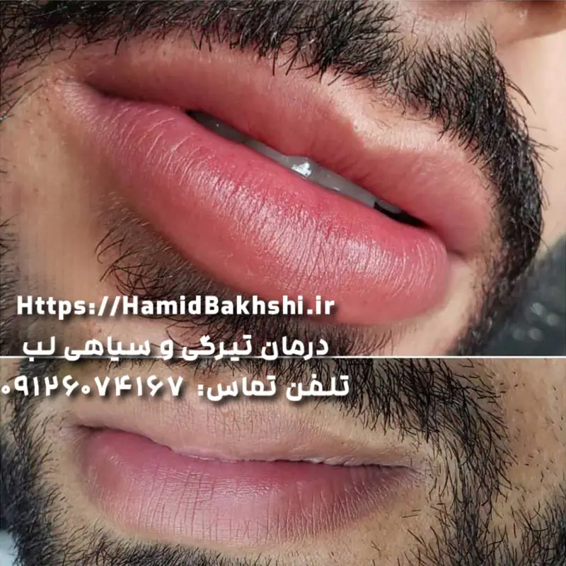 شیدینگ لب مردانه