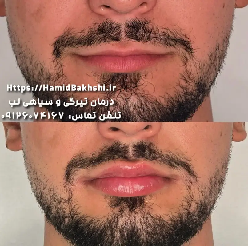 شیدینگ لب مردانه