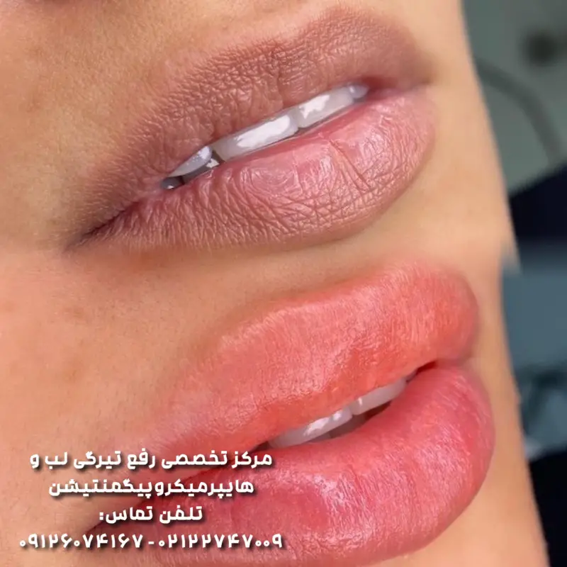 احیای رنگ لب برای آقایان و بانوان