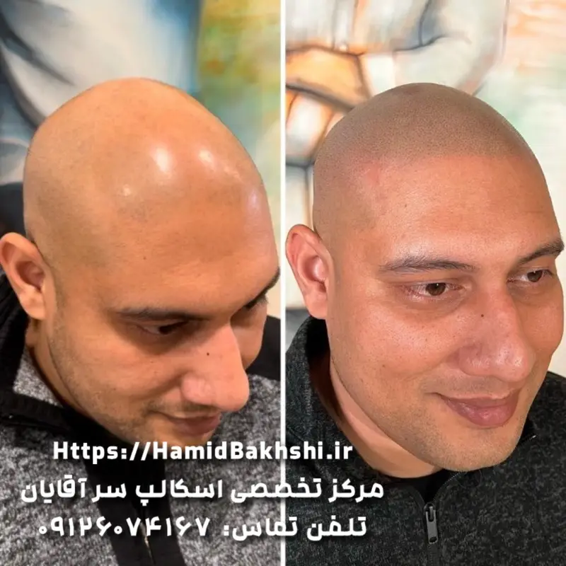 هزینه اسکالپ سر مردانه