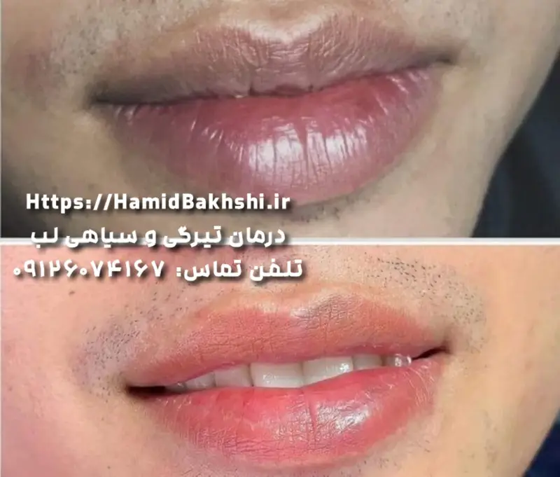 شیدینگ لب برای آقایان