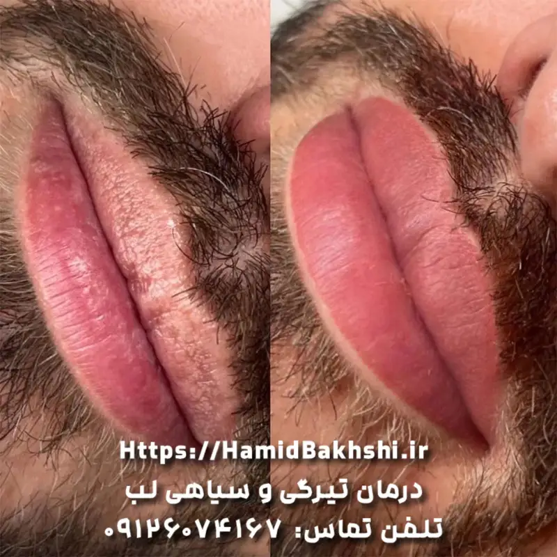 شیدینگ لب آقایان
