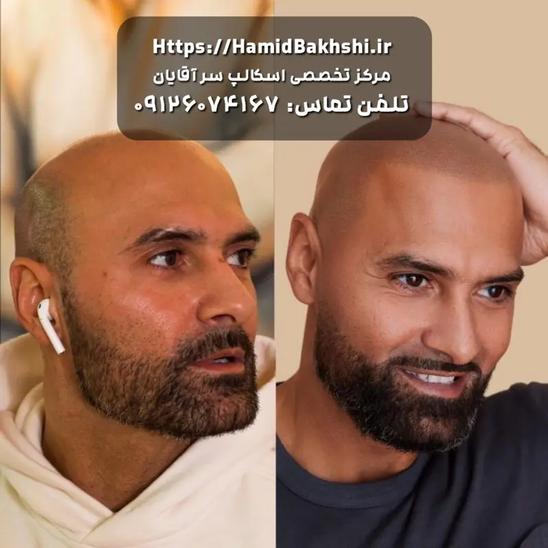 هزینه اسکالپ سر مردانه