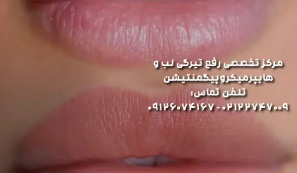 احیا رنگ لب در تهران