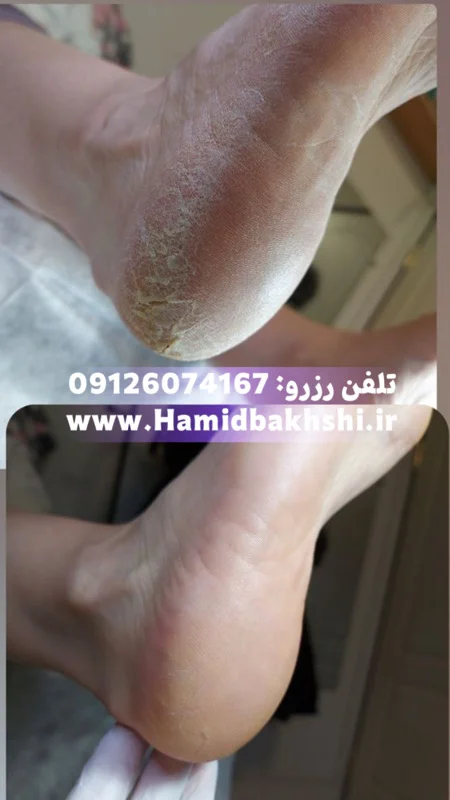 درمان ترک پا در آقایان با کفسابی مردانه