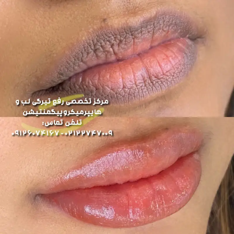 رفع کبودی لب