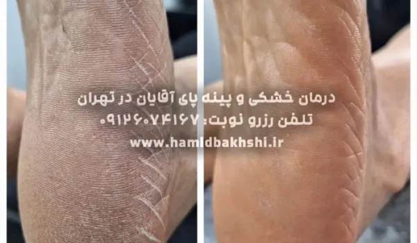 درمان خشکی کف پا آقایان
