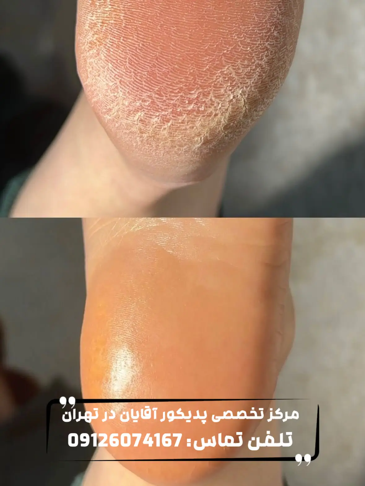 عکس قبل و بعد از درمان ترک پا