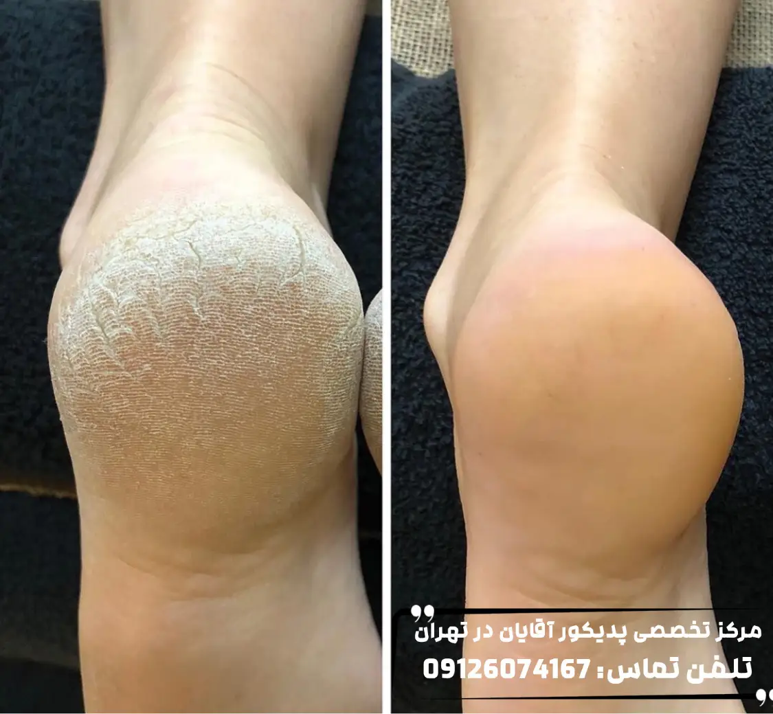 عکس قبل و بعد ترک پا آقایان