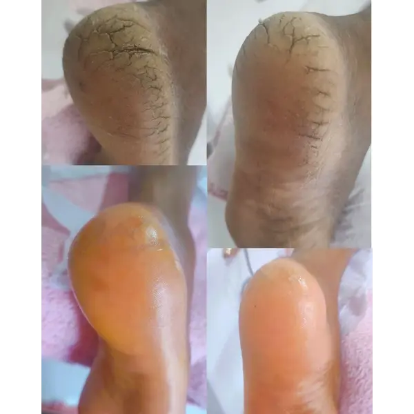 هزینه لایه برداری پا برای آقایان