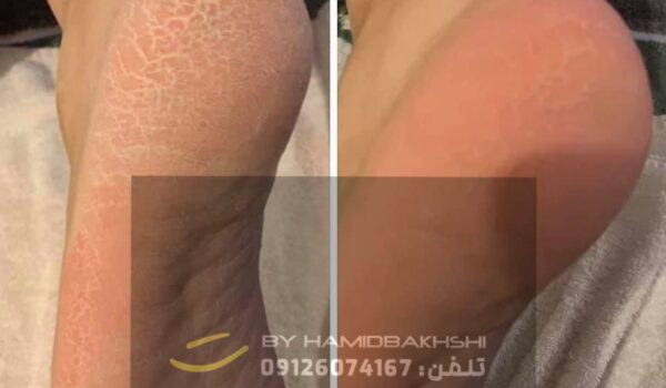 درمان ترک پاشنه پا در آقایان
