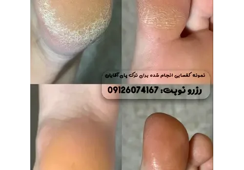 ترک پا