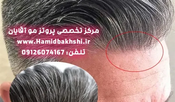 قیمت پروتز مو جوگندمی در تهران چقدره؟