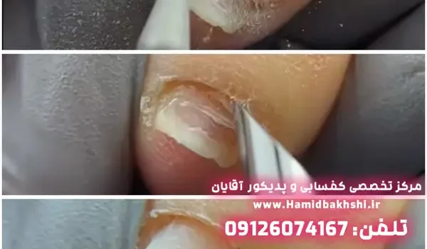 لایه برداری ناخن آقایان