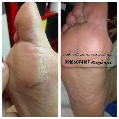 بهترین کرم برای ترک پا